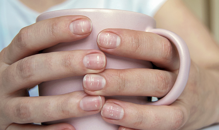10 заболеваний и проблем с ногтями: о чем они говорят?