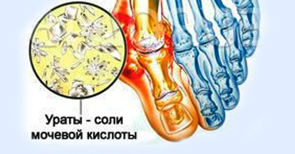 подагра0809