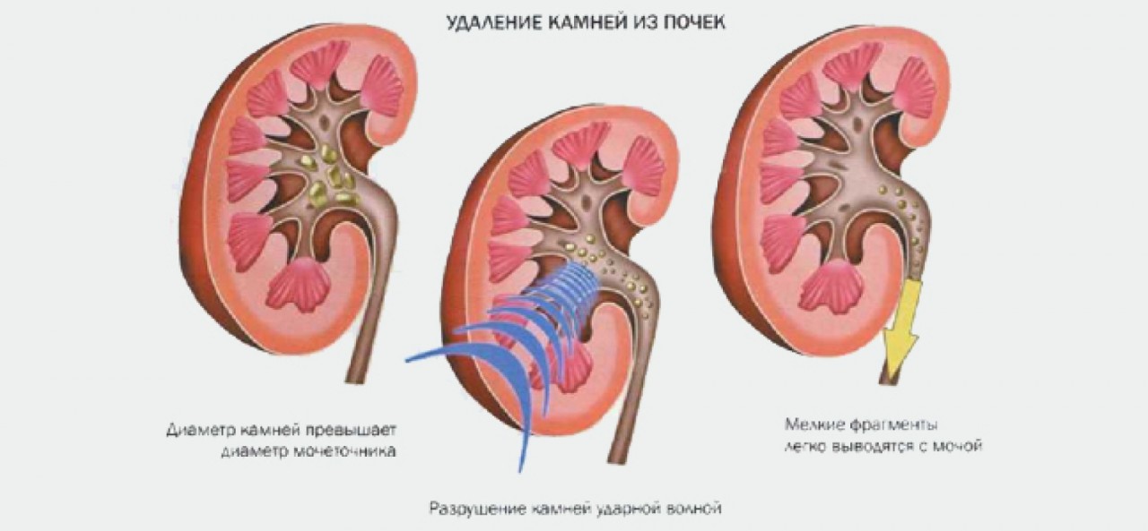 Ð›ÐÑ‡ÐÐ½Ð¸ÐÂ Ð¼Ð¾Ñ‡ÐÐºÐÐ¼ÐÐ½Ð½Ð¾Ð¹ ÐÐ¾ÐÐÐÐ½Ð¸