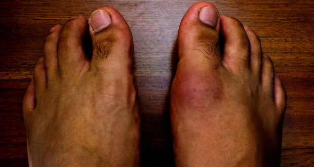 Home-Remedies-for-Gout