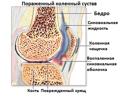 Пауциартикулярный юношеский артрит: лечение, симптомы и профилактика Пауциартикулярный юношеский артрит: лечение, симптомы и профилактика