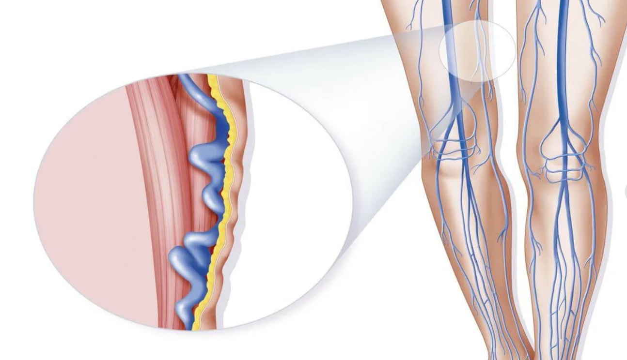 Варикозно Расширенные Вены