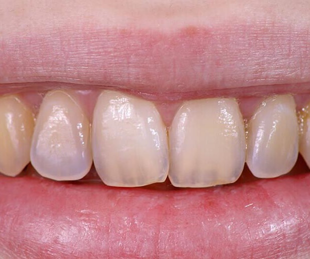 medRxiv: энергетики с кальцием в составе защищают зубную эмаль от эрозии