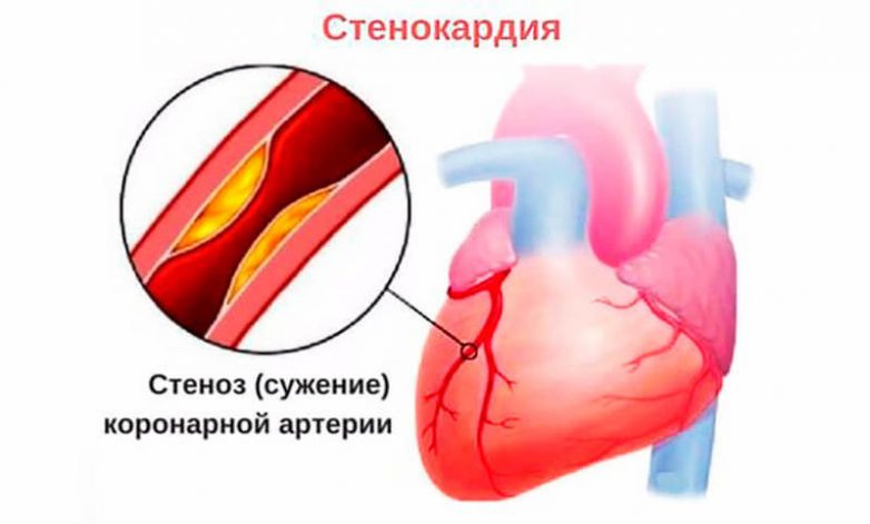 Первая помощь при приступе стенокардии