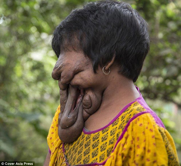 Без лица: девушка с огромными наростами на лице довольная своей жизнью