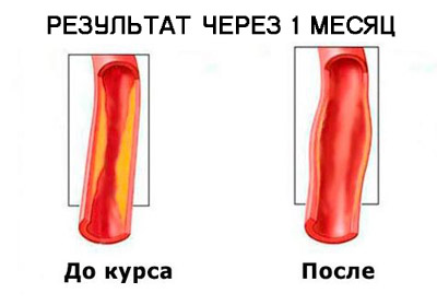 ГИПЕРТОНИЯ УХОДИТ МГНОВЕННО! Поразительное открытие в лечении гипертонии