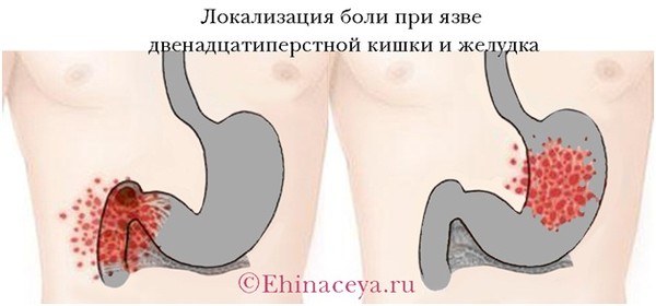 Как снять боли в кишечнике в домашних условиях Как снять боли в кишечнике в домашних условиях