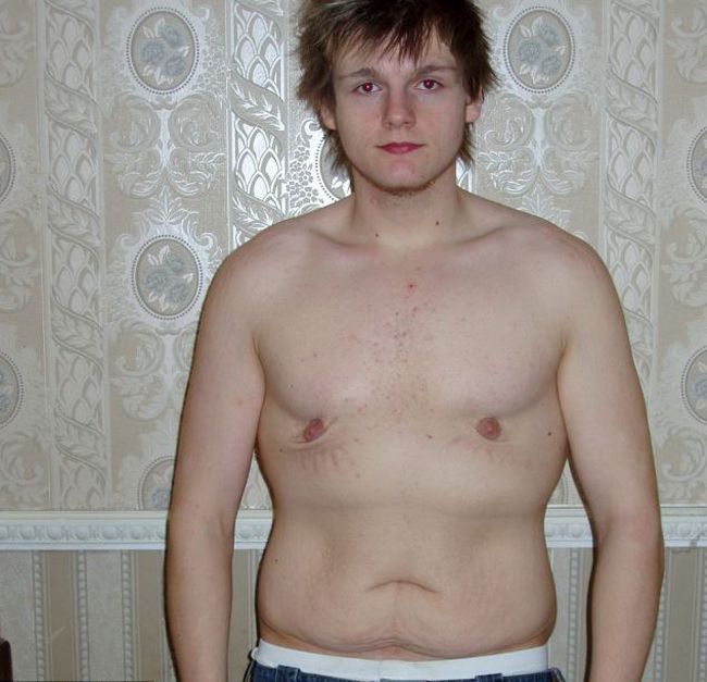 Парень сбросил 76 килограмм и стал совершенно другим человеком вес, похудение, тогда и сейчас