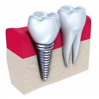 Кто имеет право на бесплатное протезирование? Кто имеет право на бесплатное протезирование?