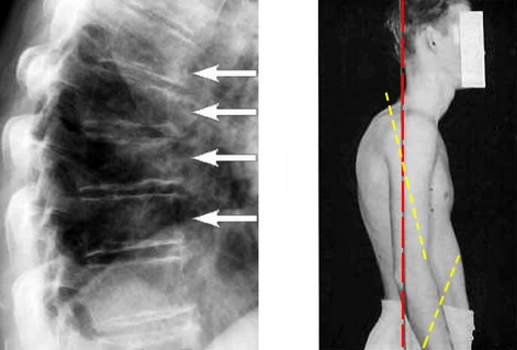 Artroz grudnogo otdela pozvonochnika