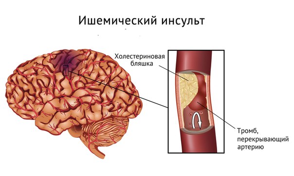 После инсульта мозга После инсульта мозга