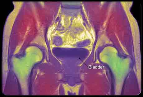 Скан МРТ мочевого пузыря Скан МРТ мочевого пузыря
