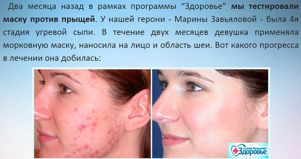 Маска на лицо от угрей и прыщей в домашних условиях Маска на лицо от угрей и прыщей