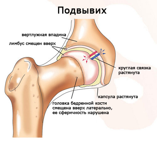 Podvy-vih-tazobedrennogo-sustava