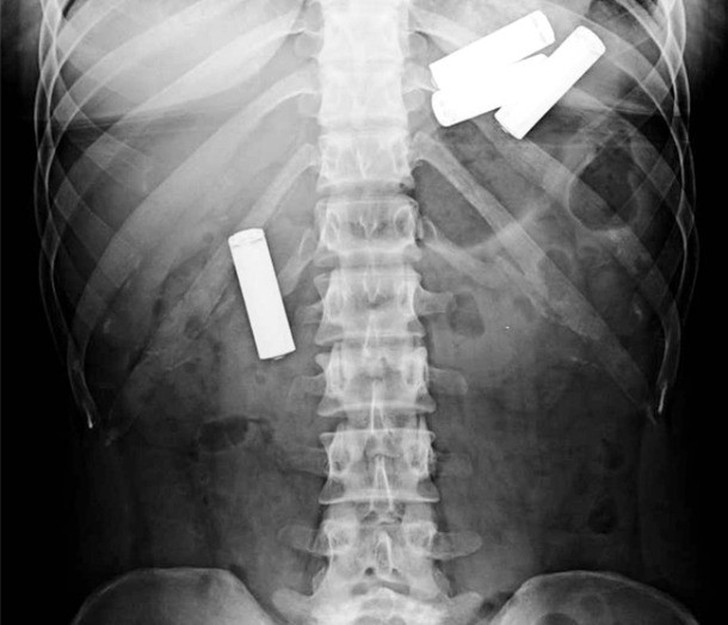 stuffinside13 Самые невероятные предметы, которые были найдены в человеческом теле