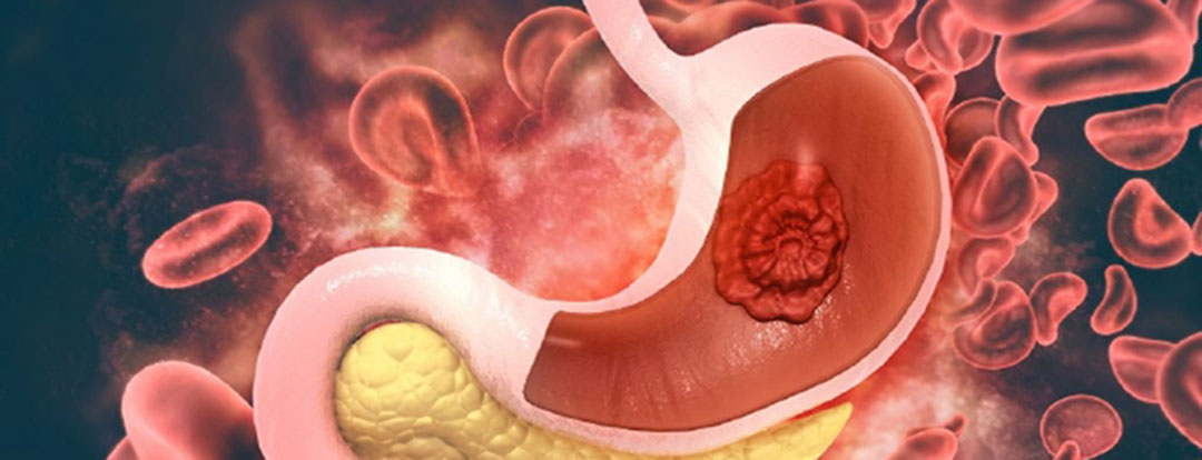 Большинство случаев рака желудка связаны с распространенными бактериями