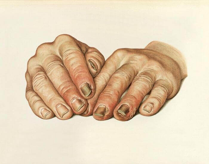 РОЖА – болезнь молодых мужчин и пожилых женщин РОЖА – болезнь молодых мужчин и пожилых женщин