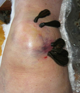 Primenenie girudoterapii pri lechenii artroza kolennogo sustava