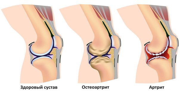 Хруст в суставах и его основной источник! Хруст в суставах и его основной источник!