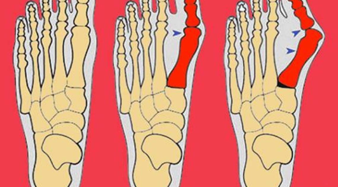 Эффективные упражнения от косточек на ногах
