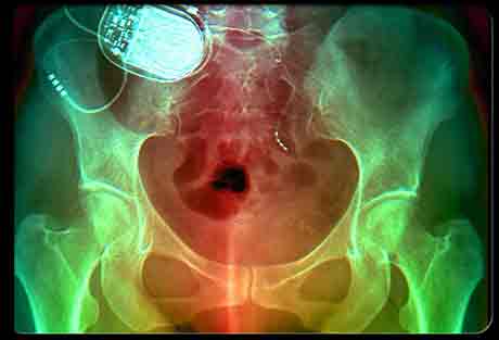 Имплантированное устройство для стимулирования нервов Имплантированное устройство для стимулирования нервов