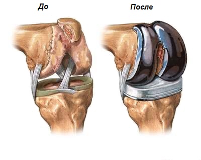 endoprotezirovanie-kolennogo-sustava
