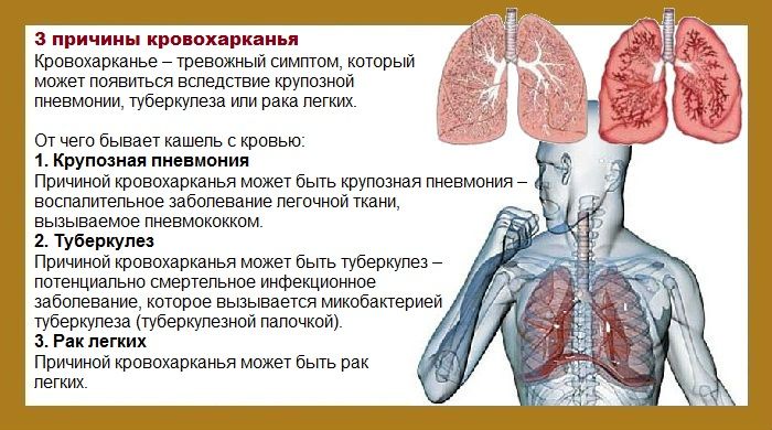 Если кашель связан с горлом Если кашель связан с горлом