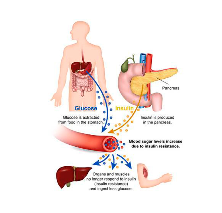 Как распознать и лечить инсулинорезистентность