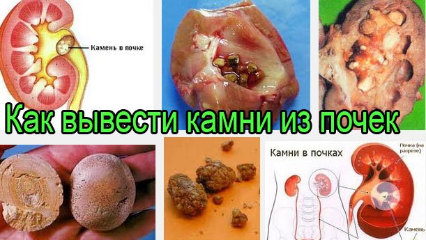 Песок и камни в почках: выход есть Песок и камни в почках: выход есть