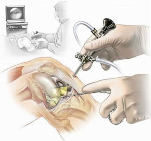 Hirurgicheskoe lechenie artroza kolennogo sustava