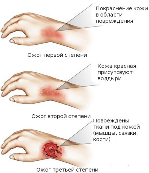 11. Ожог Лайфхак, коты, медицина, помощь, факты