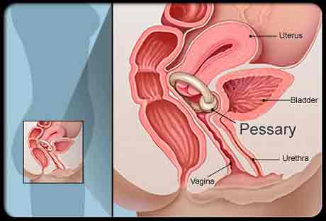 Пессарий Пессарий