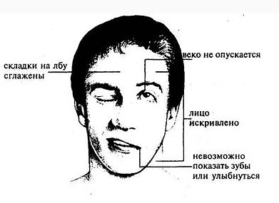 Инсульт: Это удивительный и нетрадиционный способ спасения от инсульта!