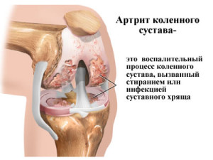 artrit-kolennogo-sustava-04
