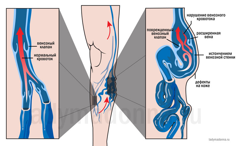 Варикоз Вен У Подростков