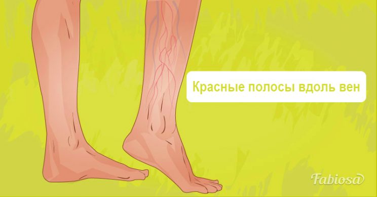 6 ПРИЗНАКОВ ТРОМБА, КОТОРЫЕ НИ В КОЕМ СЛУЧАЕ НЕЛЬЗЯ ИГНОРИРОВАТЬ 6 ПРИЗНАКОВ ТРОМБА, КОТОРЫЕ НИ В КОЕМ СЛУЧАЕ НЕЛЬЗЯ ИГНОРИРОВАТЬ