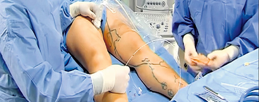 Сегодня тромбы удаляют или рассасывают при помощи катетера, введённого в вену через небольшой разрез