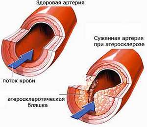 Народные рецепты лечения атеросклероза Лекарственные растения в рецептах от атеросклероза