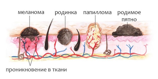 Лечение папиллом на попе