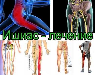 Как лечить седалищный нерв народными средствами Как лечить седалищный нерв народными средствами