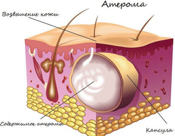 ÐšÐÐš Ð¸ÐÐÐÐ²Ð¸Ñ‚ÑŒÑÑ Ð¾Ñ‚ ÐÑ‚ÐÑ€Ð¾Ð¼Ñ‹ Ð¿Ñ€Ð¸ Ð¿Ð¾Ð¼Ð¾Ñ‰Ð¸ Ð¿ÐÐÐ½ÐºÐ¸ Ð¾Ñ‚ ÐºÑƒÑ€Ð¸Ð½Ñ‹Ñ… ÑÐ¸Ñ†