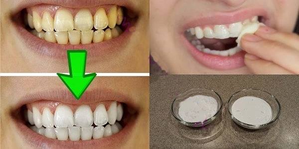 Гарантированное отбеливание желтых зубов менее чем за 2 минуты