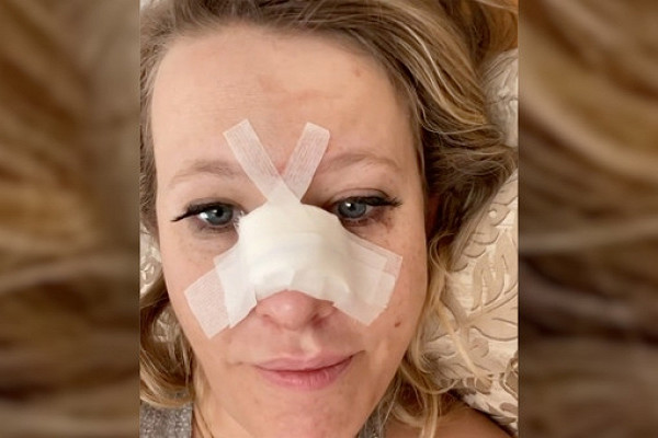 «Я в больнице»: Собчак рассказала о переломе носа и сотрясении