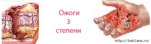 Как лечить народными средствами ожог 3 степени Как лечить народными средствами ожог 3 степени