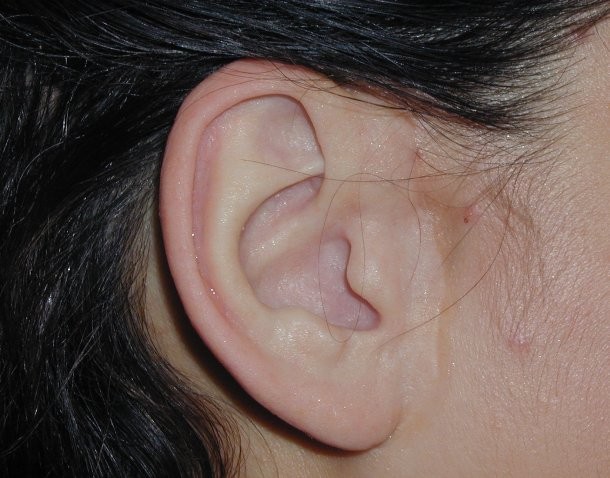 earcommunity.com-1600-×-1200-Option-3-Prosthetic-ear-attached-by-magnet-components-610x478