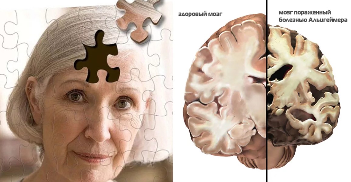 В России нашли препарат, сохраняющий нервные клетки при Альцгеймере
