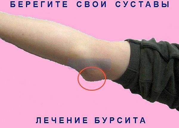 alt="Как лечить бурсит"