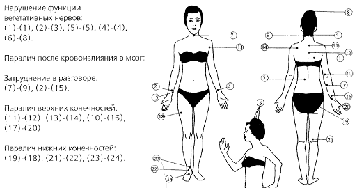 нарушение функции вегетативных нервов, паралич после кровоизлияния в мозг, затруднение в разговоре, паралич верхних конечностей, паралич нижних конечностей.