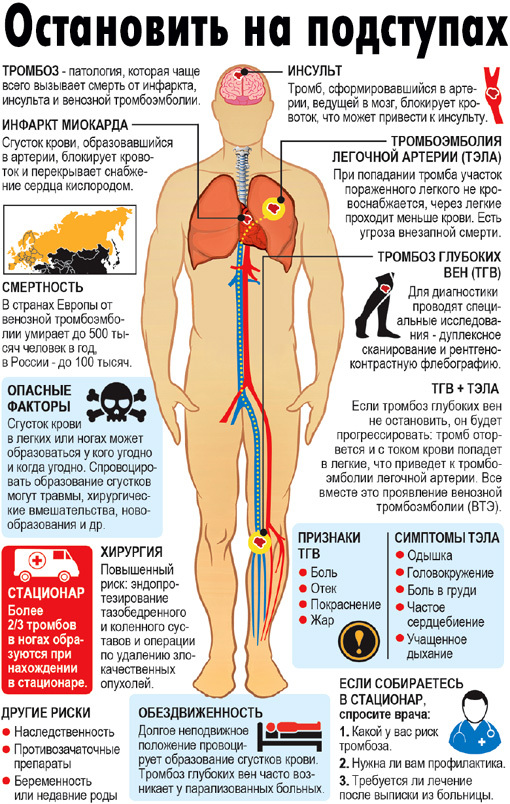 Тромб - сгусток смерти