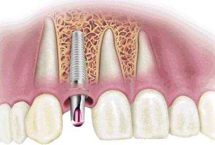 Зубные импланты: краткий, но необходимый ликбез